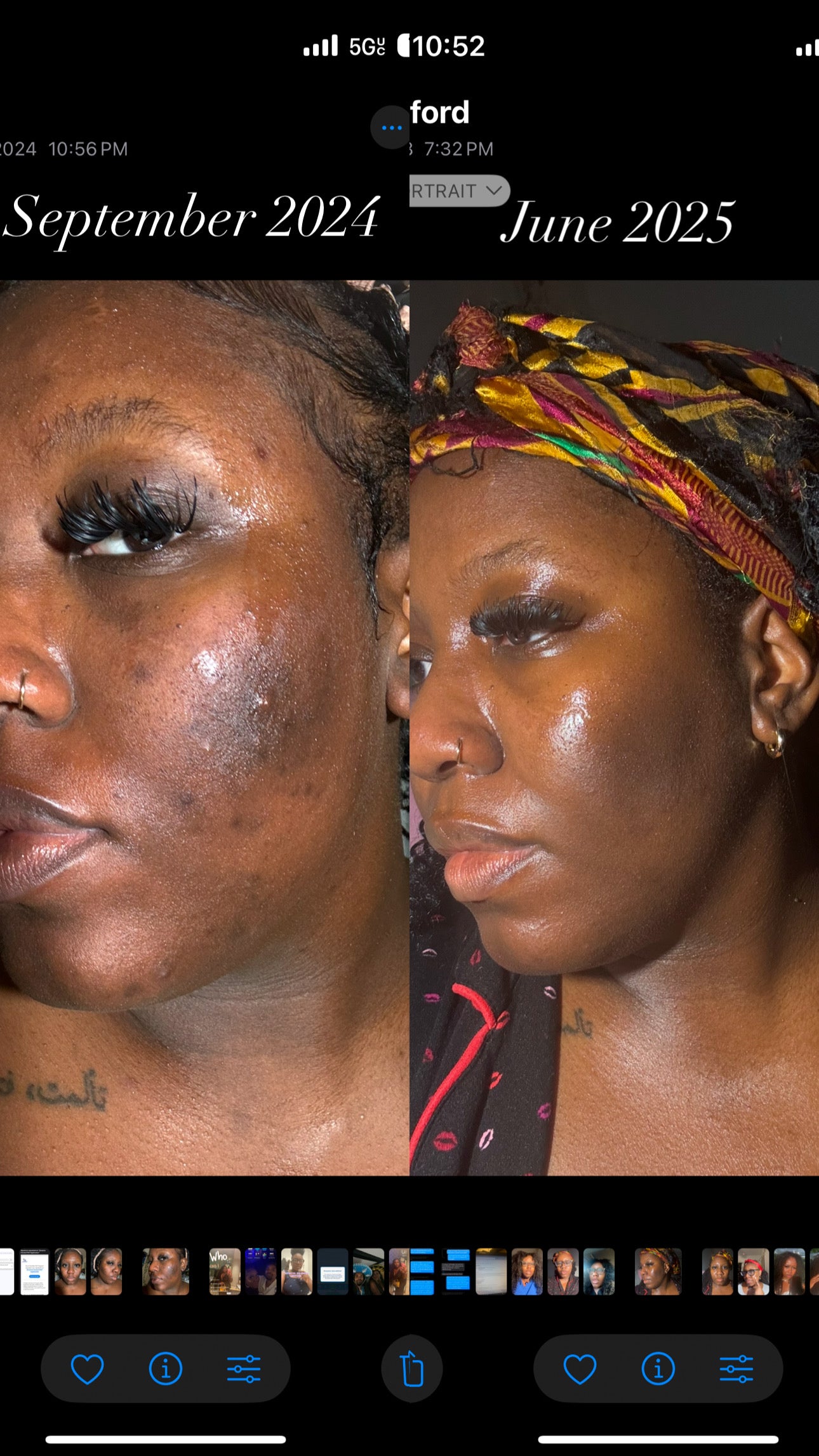 Glow Reset Bundle – Hyperpigmentation,Acne Hormonal Acne and