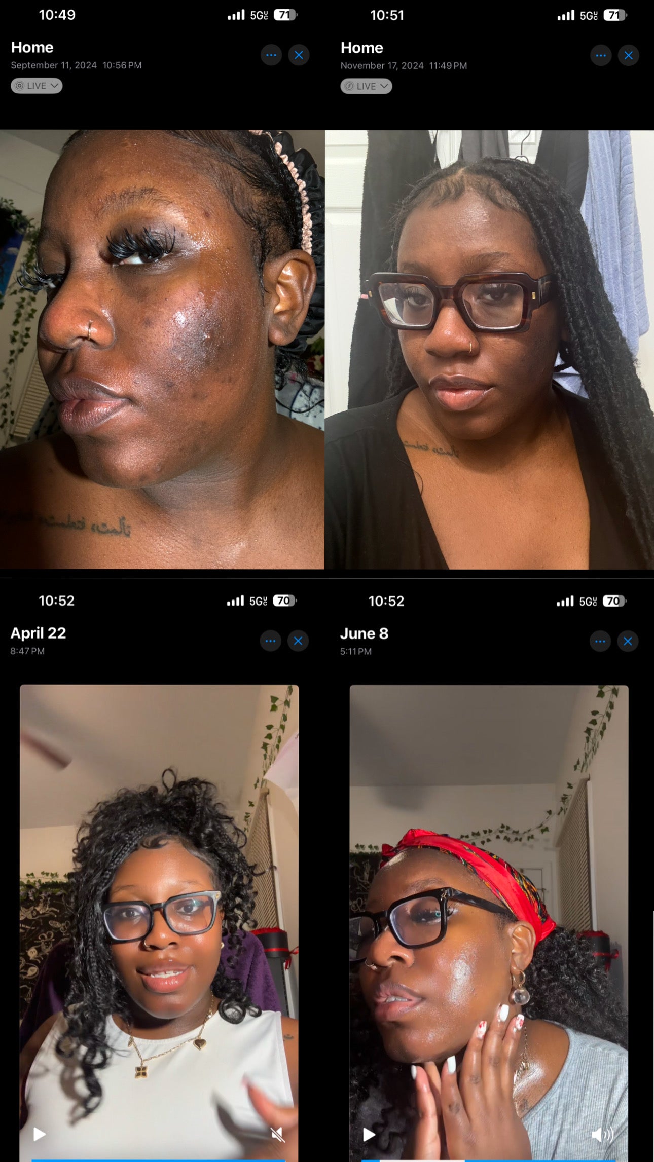 Glow Reset Bundle – Hyperpigmentation,Acne Hormonal Acne and