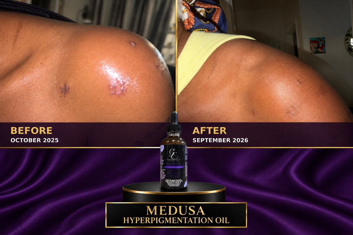 Medusa Hyperpigmentation Oil before and after