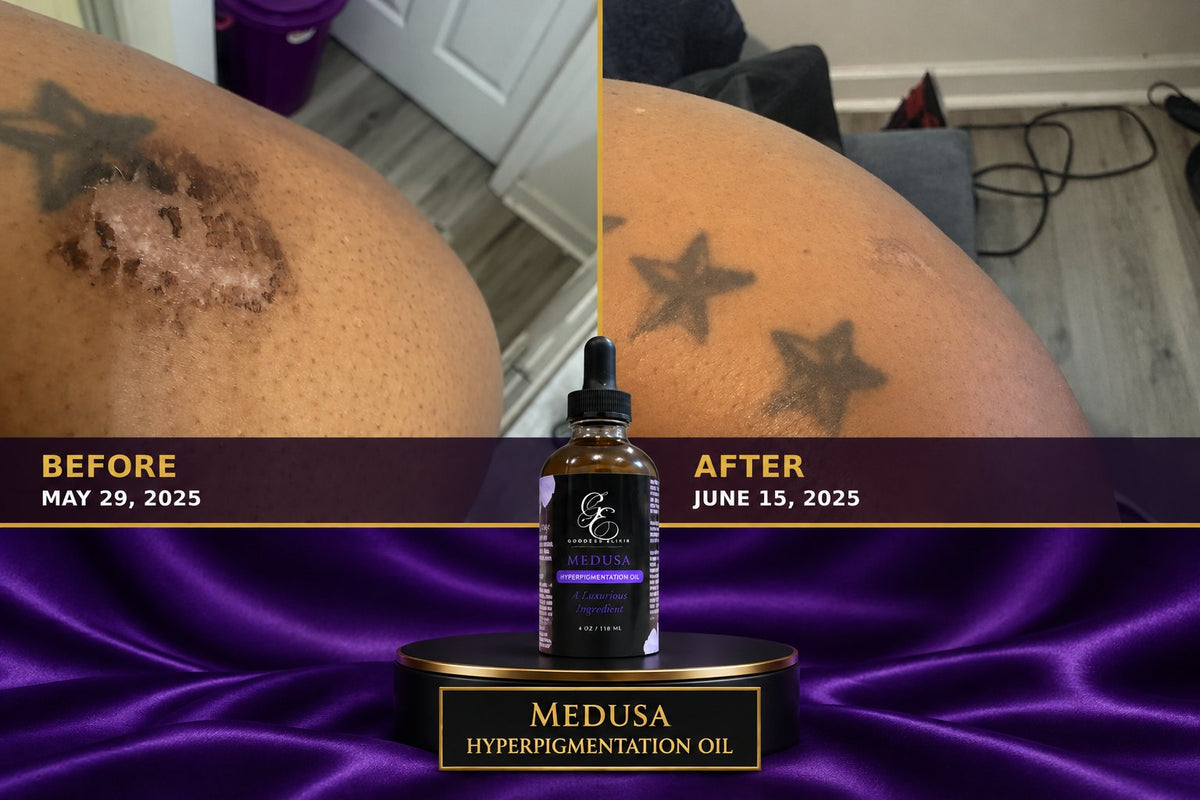 Medusa Hyperpigmentation Oil before and after