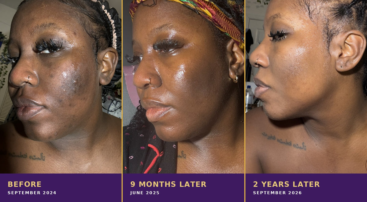 Breanna's skin in September 2024, June 2025 and September 2026